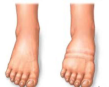 Visibly Reduces Swelling & Edema